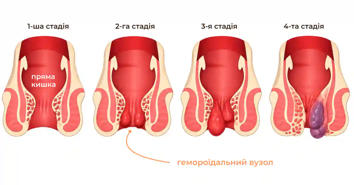 Стадії геморою